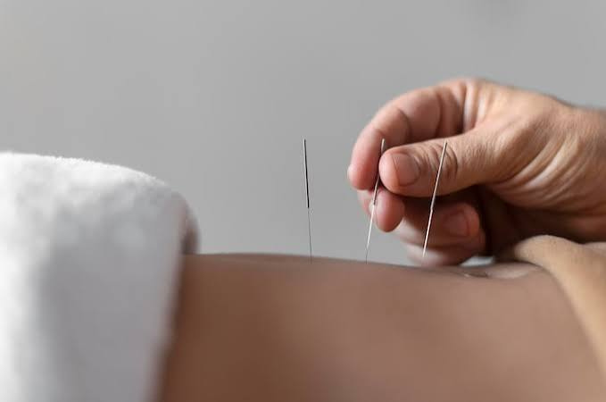 Tratamiento de acupuntura — inserción de agujas
