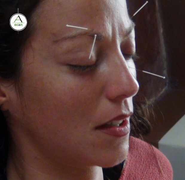 Acupuntura facial en Ubud, Bali