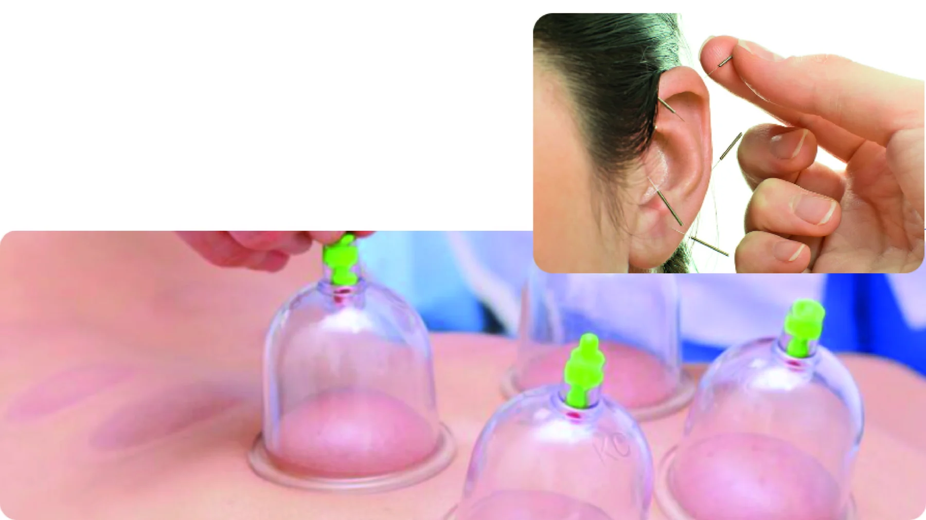 Auriculoterapia: agujas en la oreja; ventosas sobre la espalda